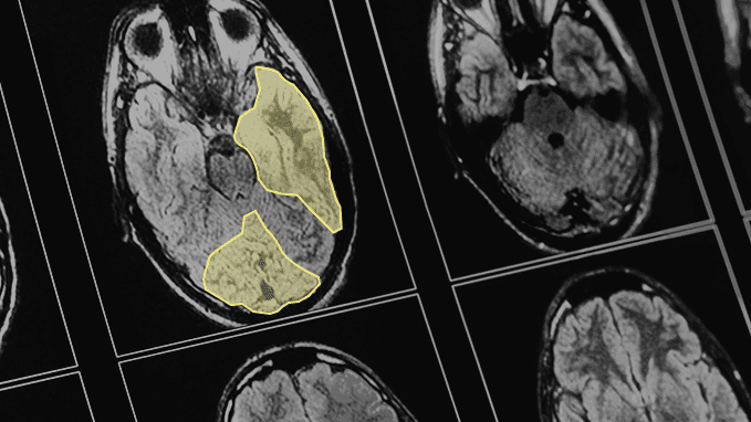 Image illustrating highlighted segments on a brain MRI film.